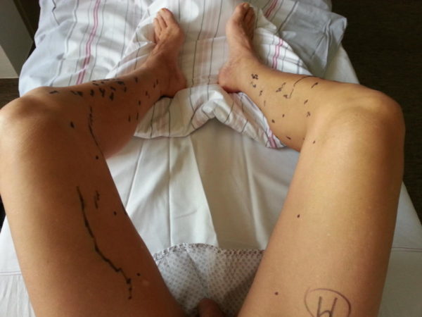 2019-02-13 - Krampfader-OP - hier gehts lang