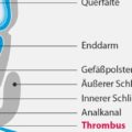 Infografik-Analvenenthrombus