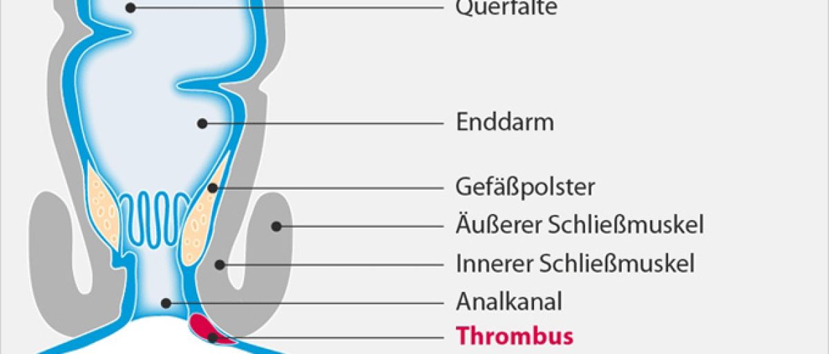2018-09-21 – Perianalthrombose